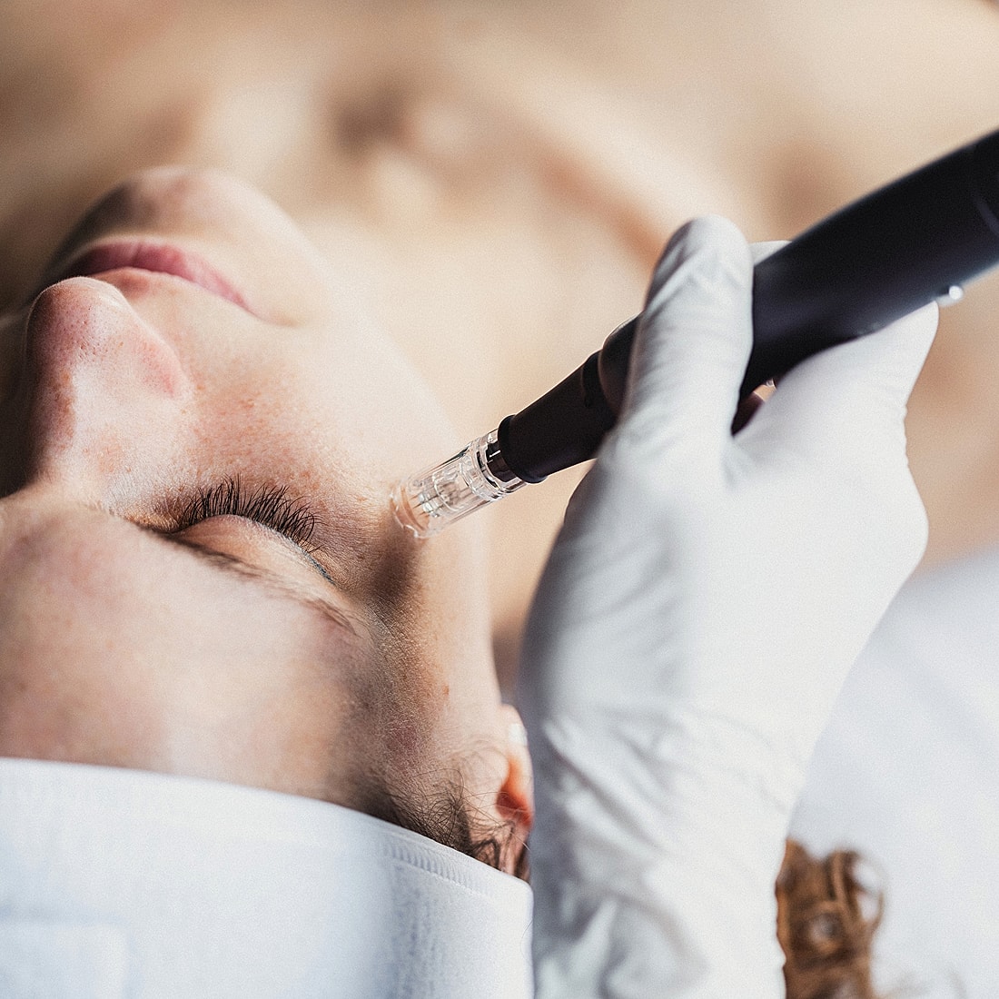 Micro-needling facial treatment in progress.